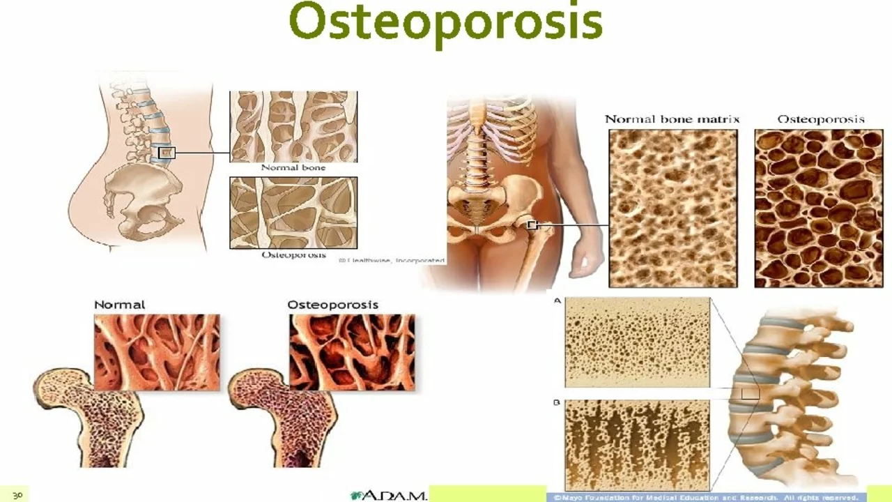The impact of calcitonin on bone health and osteoporosis prevention