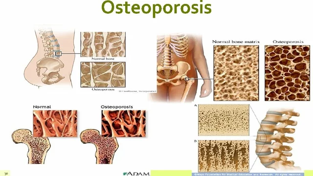 The impact of calcitonin on bone health and osteoporosis prevention