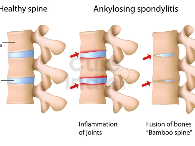 The Role of Stress in Ankylosing Spondylitis: How to Manage It